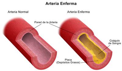 ARTERIOSCLEROSIS