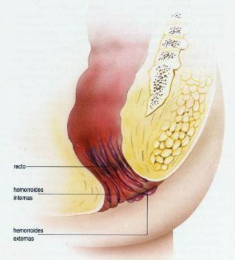 HEMORROIDES