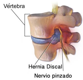 HERNIA DE DISCO