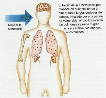 TUBERCULOSIS