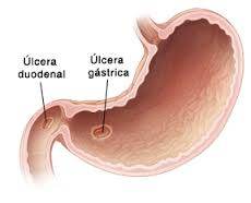 ÚLCERA GASTRODUODENAL