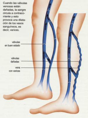 VARICES