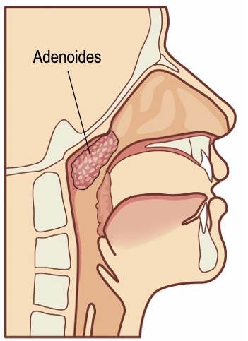 VEGETACIONES O ADENOIDES