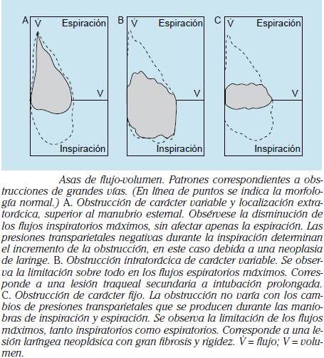 ALTERACIÓN VENTILATORIA TIPO OBSTRUCTIVO