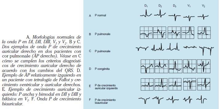 ALTERACIONES DEL AURICULOGRAMA