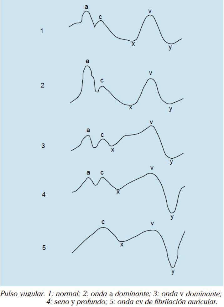 ALTERACIONES DEL CONTORNO PULSÁTIL YUGULAR