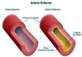 ANGIOLOGÍA E HIPERTENSIÓN ARTERIAL