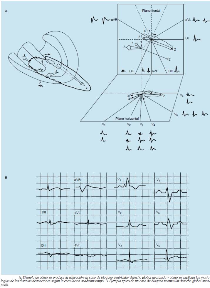 BLOQUEO VENTRICULAR