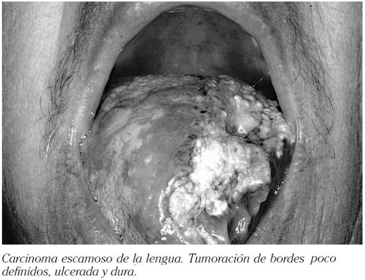 LESIONES PREMALIGNAS Y MALIGNAS