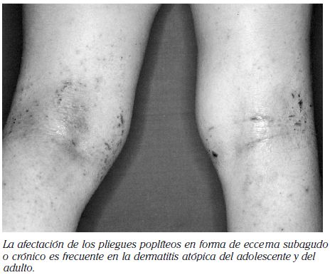 Dermatitis atópica