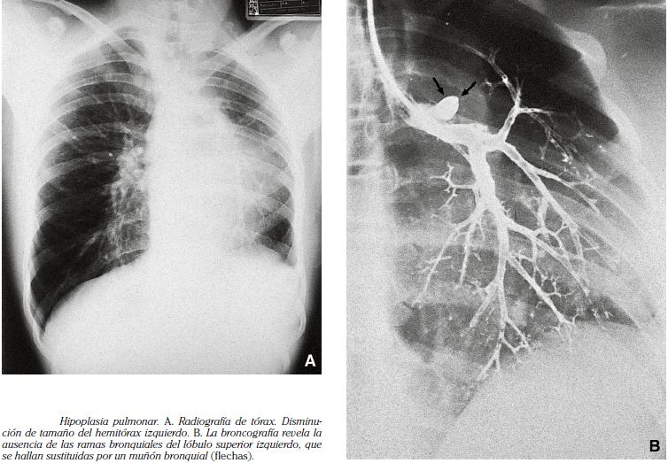 MALFORMACIONES PULMONARES