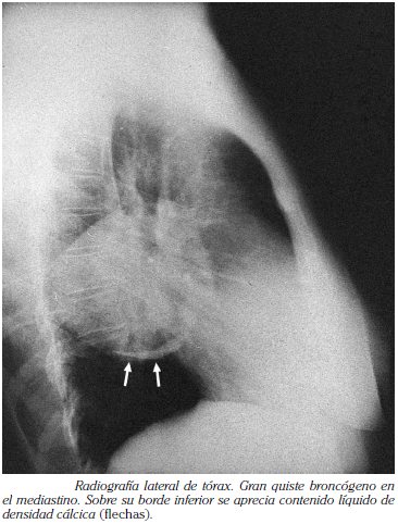 Radiografía lateral de tórax