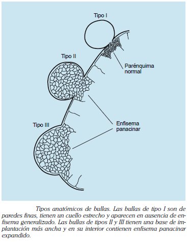 Tipos anatómicos de bullas